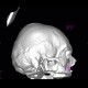 Fissure of skull, epidural hematoma: CT - Computed tomography